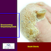 Overcoming Onychomycosis